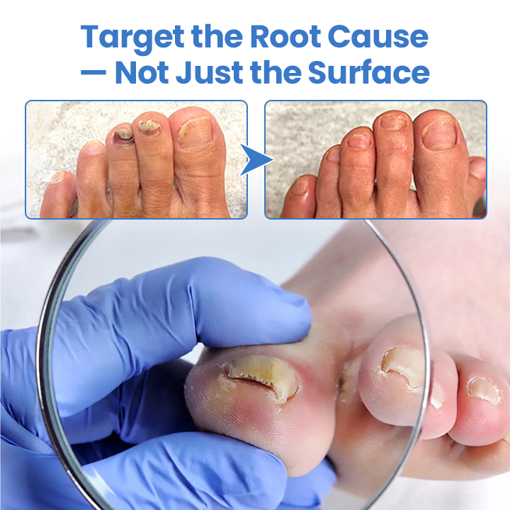 Timilk® MycoErase Nail Revive Pen