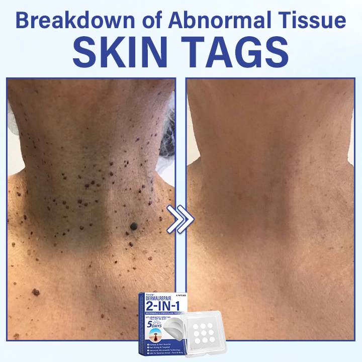 🔥Timilk® DermalRepair 2-in-1 Microneedle & Hydrocolloid Patch 💉| Raised Moles, Acne, Flat Warts & Skin Tags Remover | Improves Wrinkles, Scars & Blemishes | Invisible Pimple Patches for Face & Body💎