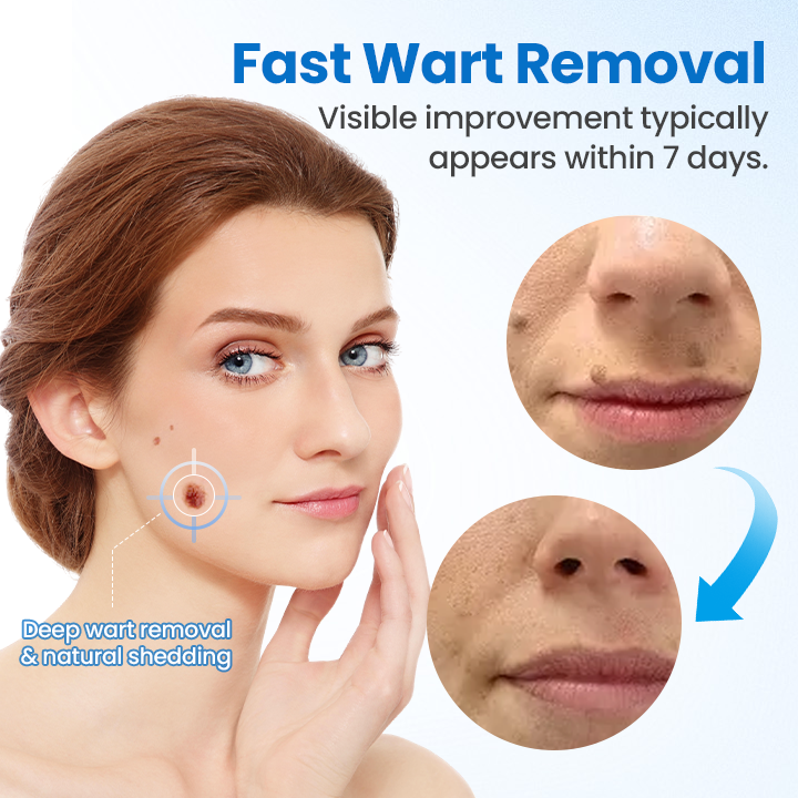 Timilk® TagGone Wart Removal Cream 💝