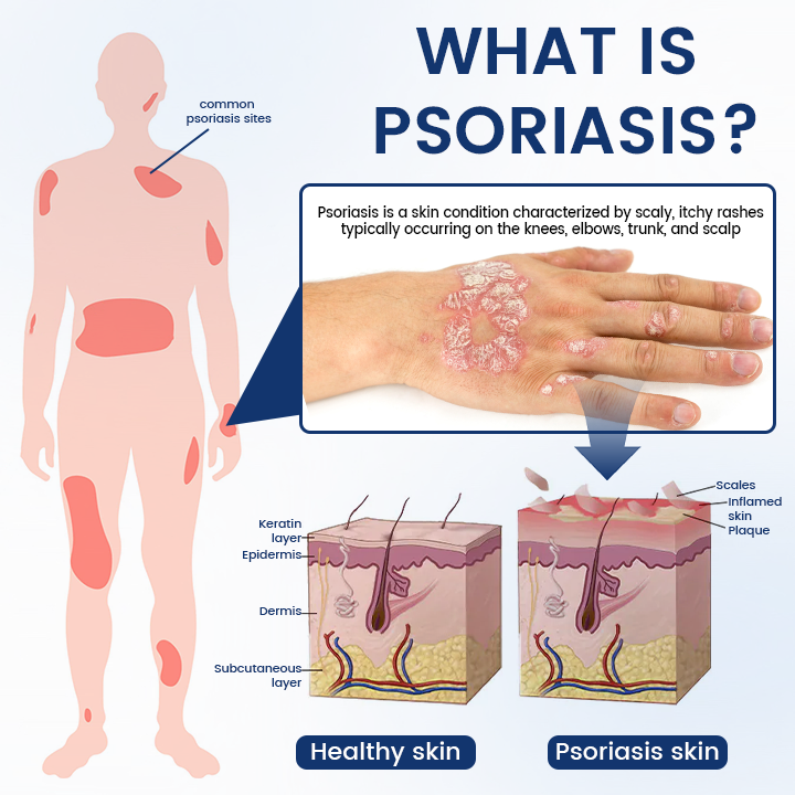 Timilk® PsoriCure Magnesium Herbal Spray