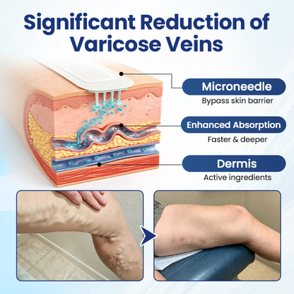 Timilk® Deep Vein Repair Microneedle Patch