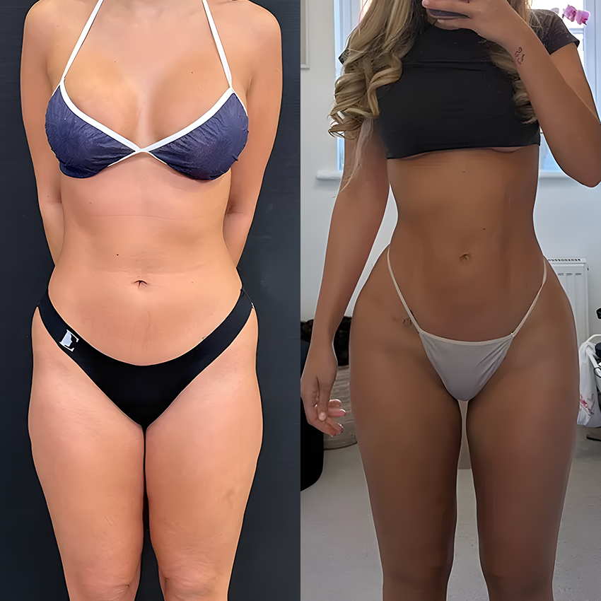 Ceoerty® Curvessa Micro-Needle Sculpting Patches