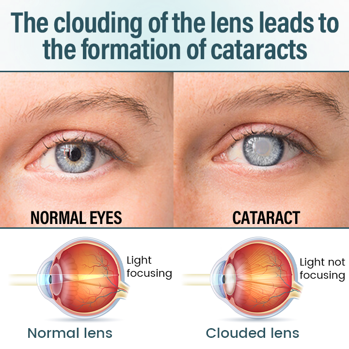 ✅ Official Store: Timilk® OptiFusion Nano Eye Drops Serum 🔥 FDA Certified (Clinically Proven to Restore Vision for Cataracts, Presbyopia, Dry Eyes & More 👁️) 🩺