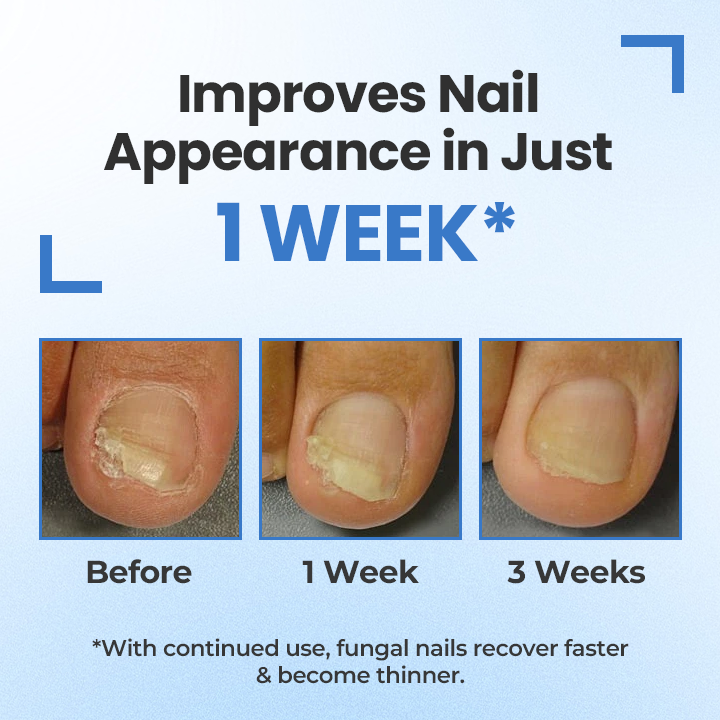 Timilk® MycoErase Nail Revive Pen