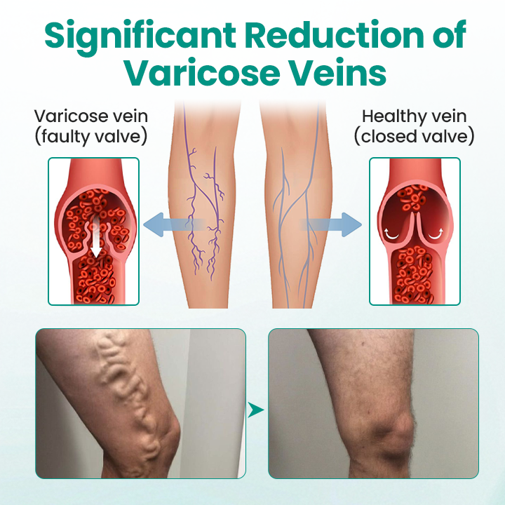 Timilk® LegRenew Varicose Veins Patch